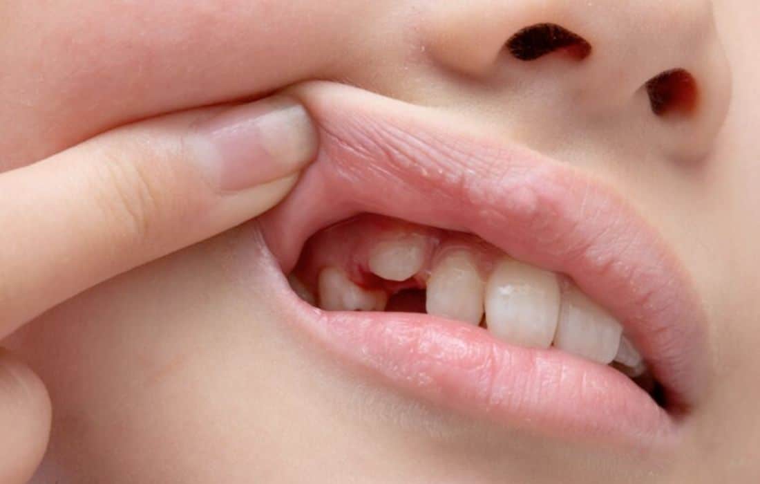 Japanese world's first tooth-regenerating drug set for human testing