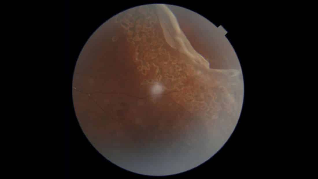 13-Year-Old Boy’s Vision Saved After Rare Eye Injury from Cricket Ball Treated at Aster Hospital Mankhool