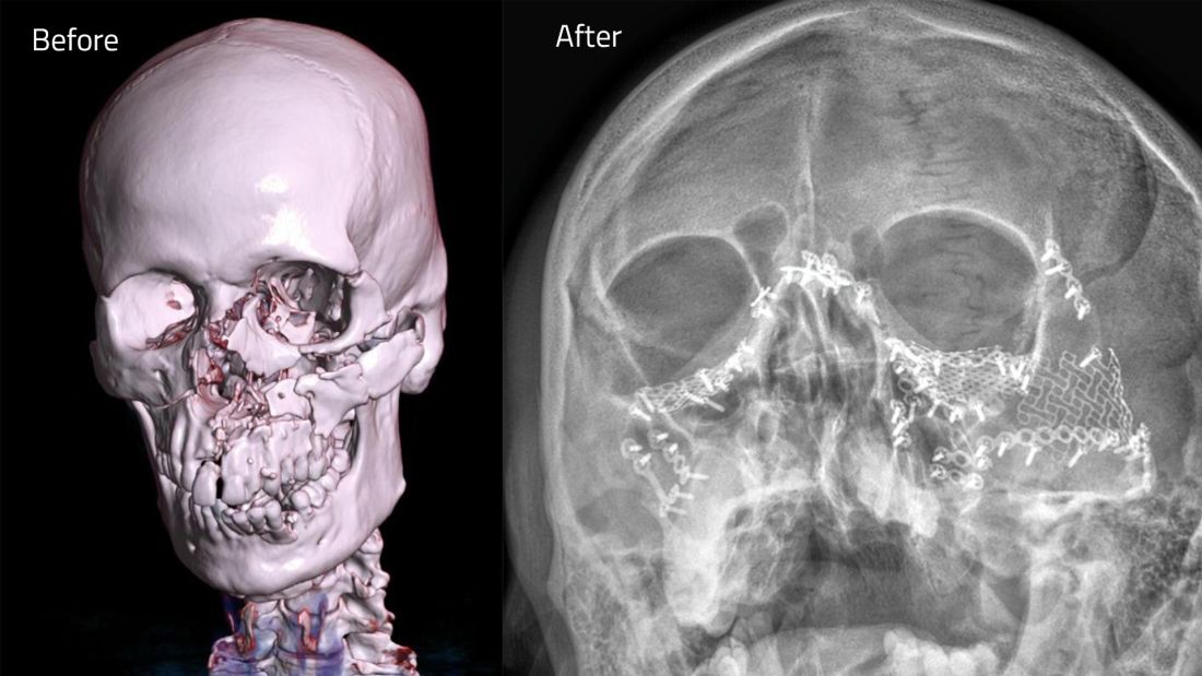 Dubai doctors perform complex pan facial reconstruction after severe accident