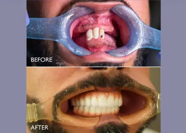 Emirati patient regains confidence after jaw reconstruction surgery in Dubai