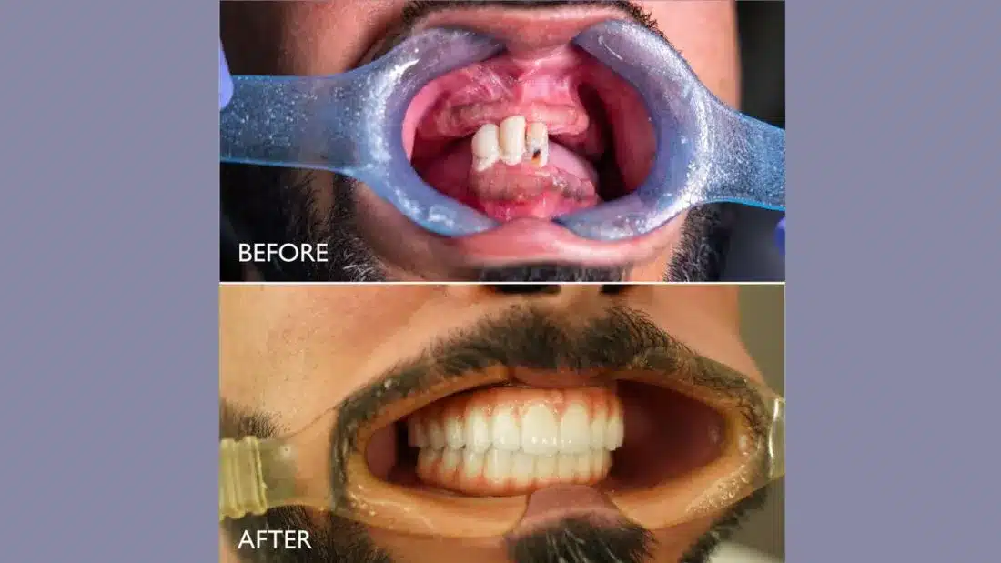 Emirati patient regains confidence after jaw reconstruction surgery in Dubai