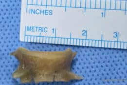 Fish Bone measuring 2 cm removed from Patient’s Airway at Aster Hospital Mankhool after 2 months of suffering