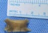 Fish Bone measuring 2 cm removed from Patient’s Airway at Aster Hospital Mankhool after 2 months of suffering