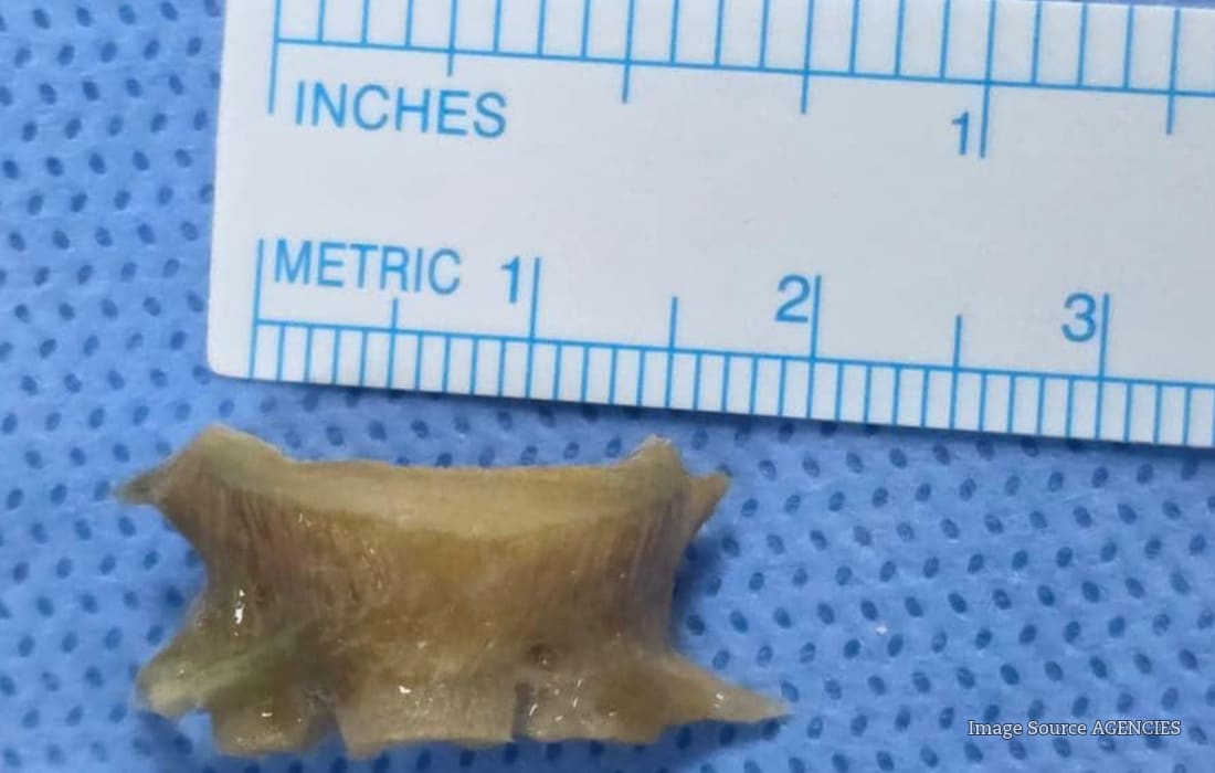Nearly 2cm fish bone removed from a patient's right main bronchus by doctors at Aster Hospital Mankhool in Duba